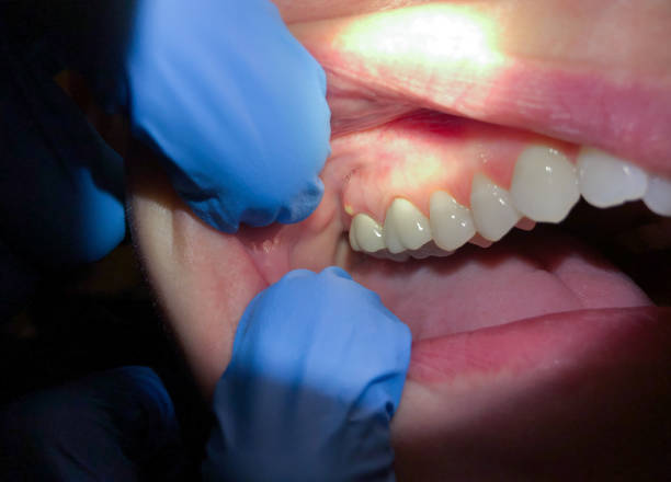 Best Emergency Treatment for Dental Infections or Abscesses in Lacoochee, FL