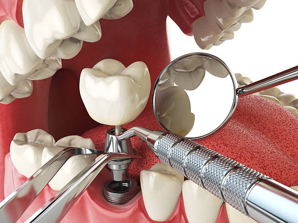 Best Emergency Gum Treatment in Lacoochee, FL